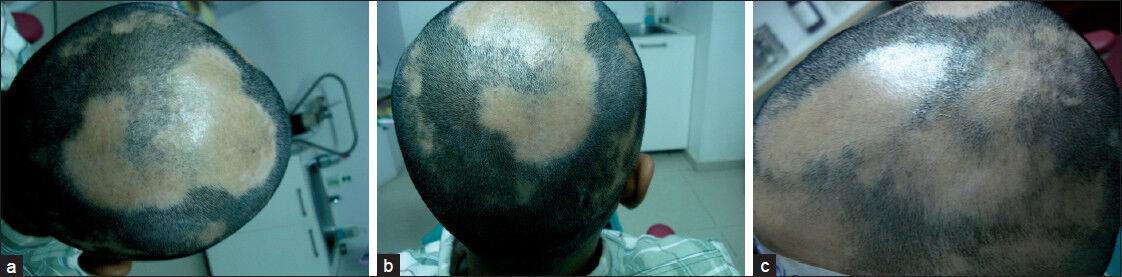 (a-c) Clinical picture of male patient showing multiple alopecic patches all over the scalp