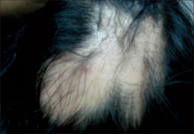 Clinical picture of the female patient showing multiple smooth surfaced alopecic patches all over the scalp