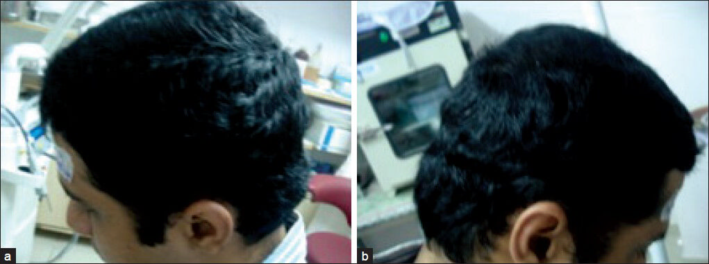 (a-b) Showing excellent hair growth after three sessions