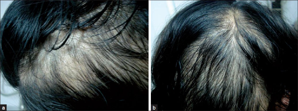 (a) Female patient after 1 session; (b) Female patient after 2nd session