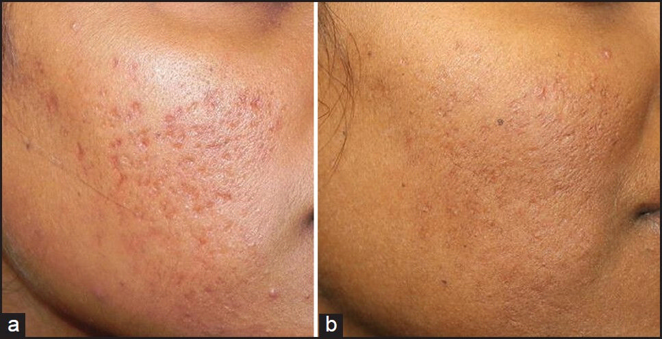 (a) Grade 3 acne scars, (b) Improvement in acne scars from Grade 3 to Grade 1 after treatment