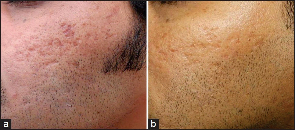 (a) Grade 3 acne scars, (b) Improvement in acne scars from Grade 3 to Grade 2 after treatment