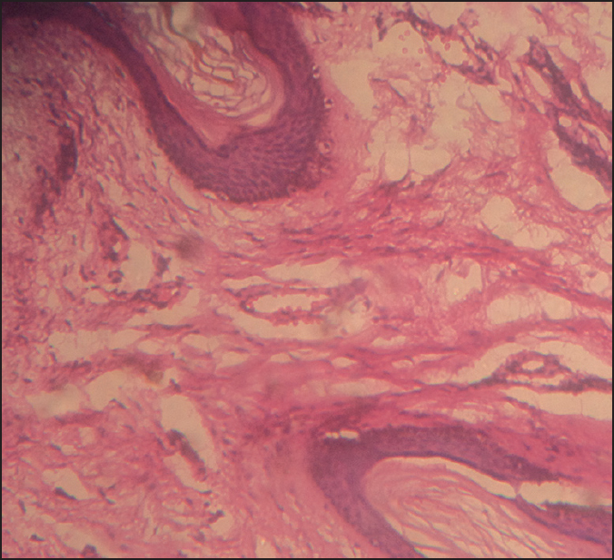 Photomicrograph showing acanthotic papillomatous epidermis with the presence of mature adipocytes (clear spaces) in the papillary dermis. [H and E, 40×]