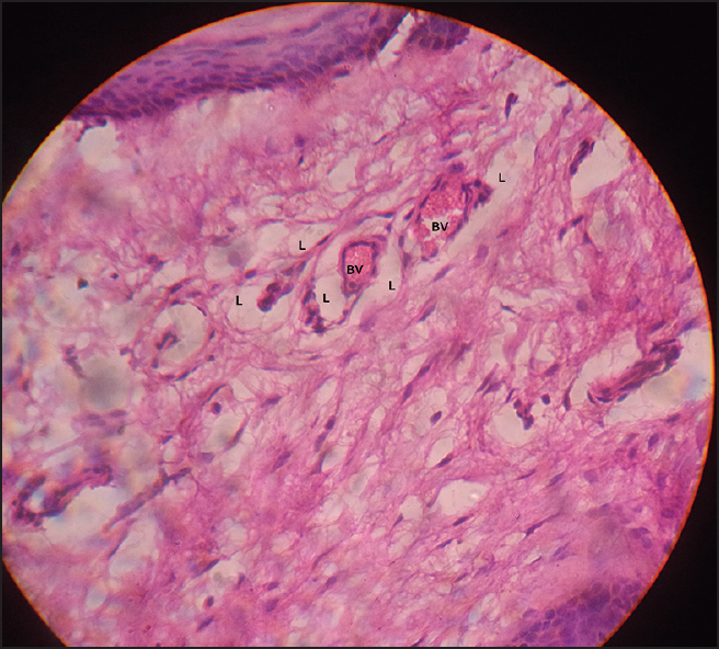 Photomicrograph showing aggregation of lipocytes (L) around the blood vessels (BV) [H and E, 40×]