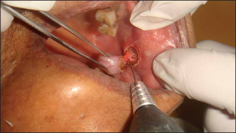 Per-operative -Excision of swelling by dental diode laser