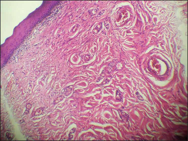 Histopathological microphotograph – showing stratified squamous epithelium and fibro-vascular connective tissue