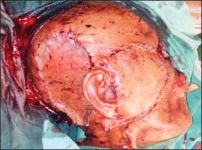 Post surgery photograph showing left-sided posterior auricular artery pedicle flap reconstruction with split skin surgery cover of donor area