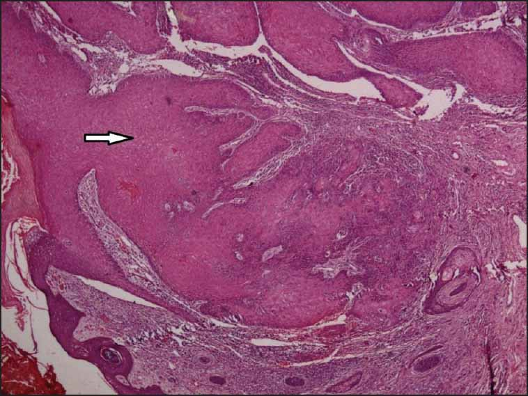 Scanner view (40×) showing marked hyperplasia of stratified squamous epithelium with epidermal invagination in dermis (white arrow), forming nodular masses made of sheets with marked inflammatory cell infiltrate in the interstitium