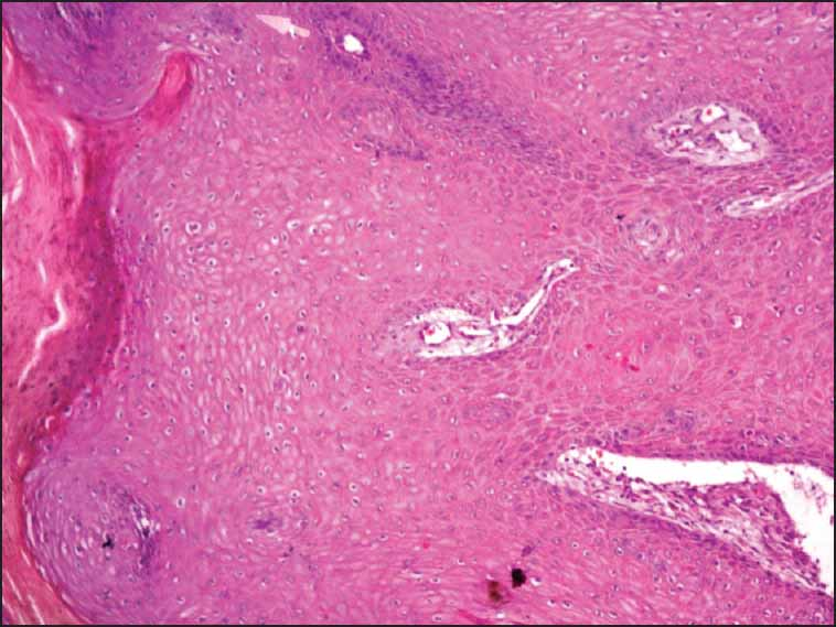 Epidermal downgrowth from the epidermis (H and E 100×)