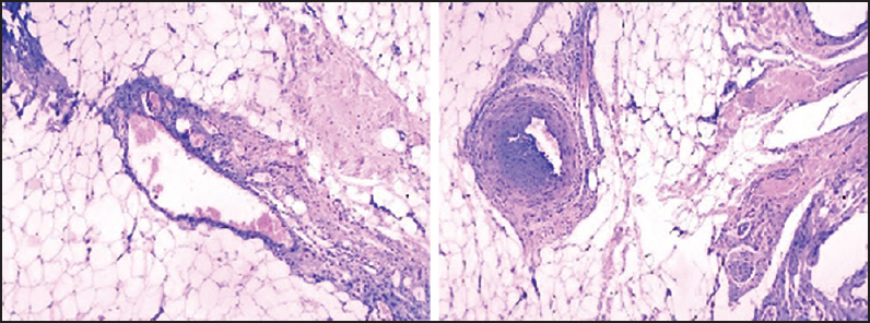 Photomicrographs showing clusters of capillaries adjacent to vein wall infiltrating the adipose tissue with admixture of thick walled blood vessel, mature adipose tissue and nerve bundles. (Haematoxylin & Eosin stain, 400 x)