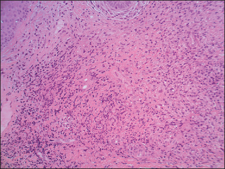 Histopathology of biopsy; high power mention magnification