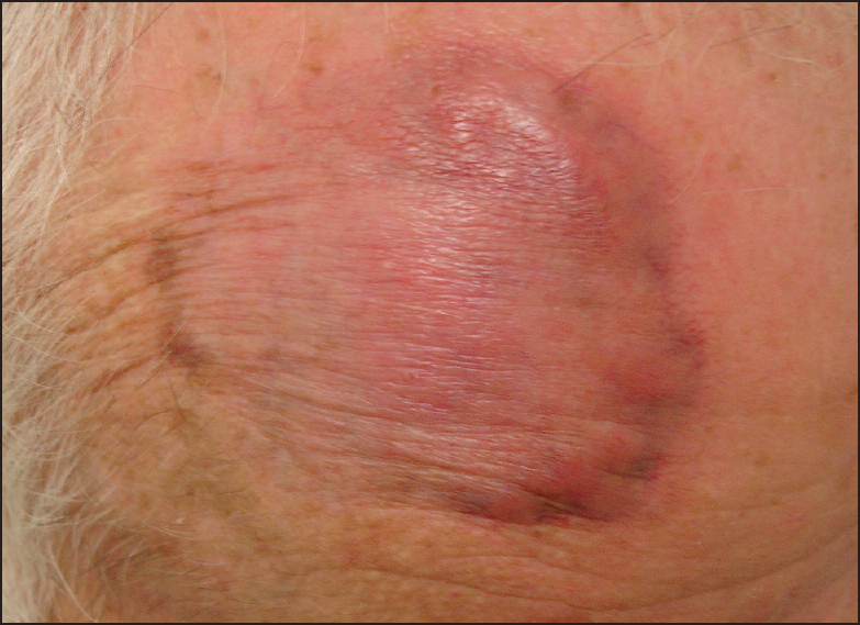 Lesion following IL corticosteroid treatment only, prior to introduction of 5FU