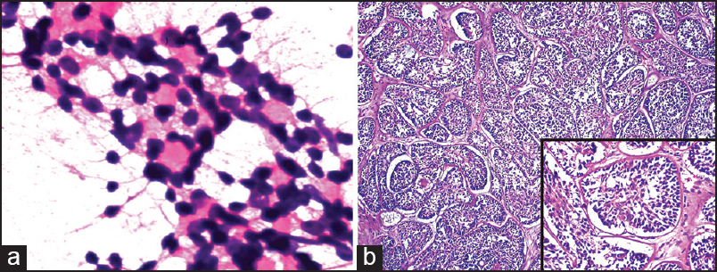 (a) [400×, H and E] FNAC smear showing basaloid cells arranged around central hyaline amorphous material. (b) [100×, H and E] Islands of epithelial cells arranged like jigsaw puzzle and separated by hyaline sheath and a narrow band of collagen. Inset [400× H and E] showing two types of cells in island, cells with small dark staining nuclei and pallisading at periphery and cells with light staining large nuclei lie in the centre