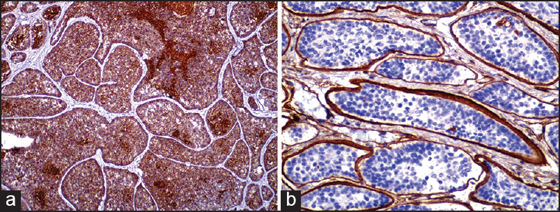 (a) CK 7 was positive in central epithelial cells. (b) Collagen IV positivity in peripheral hyaline basement membrane material