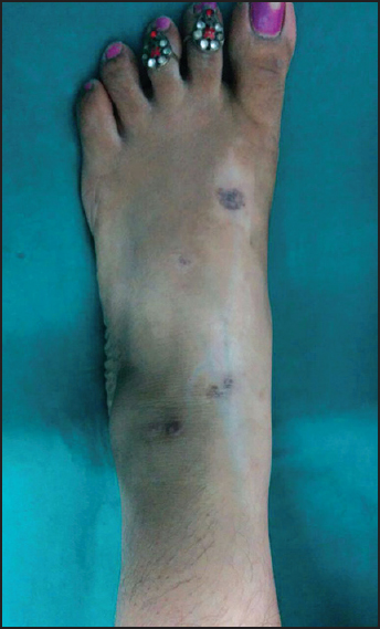 Clinical photograph showing linear depigmentation extending from left foot to left lower leg along with flattened lesions of lichen planus