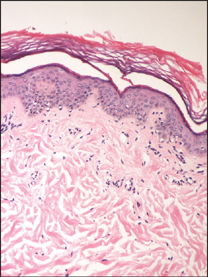 Histopathological examination (hematoxylin and eosin stain) demonstrates the presence of normal number of melanocytes with decrease melanin content (200×)