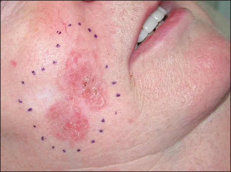 Large mixed component superficial and nodular basal cell carcinoma right on the cheek