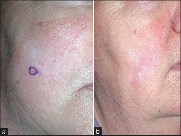 (a) Tumour shrinkage after two sessions of photodynamic therapy which was excised by MMS (b) Resultant scar at 3 months