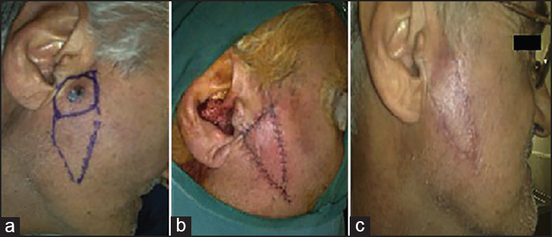 (a) A man with a basal cell carcinoma in the Pre-auricular zone of the cheek and design of the kite flap (b) Closure of the defect with no distortion of the surrounding structures after operation (c) Six months postoperatively