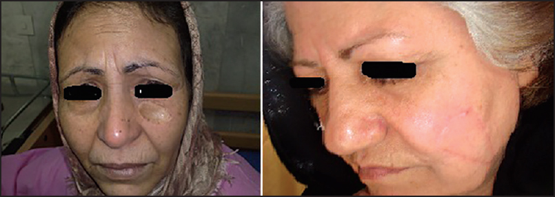 Longterm aesthetic results of skin graft and local flaps in two middle age women with a basal cell carcinoma in the Sub-orbital zone of the cheek (left) and buccomandibular zone (right)