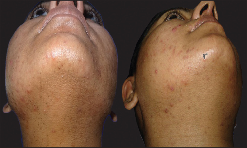 Pre and post-treatment photograph of a 28-year-old female after eight sessions of Nd: YAG laser