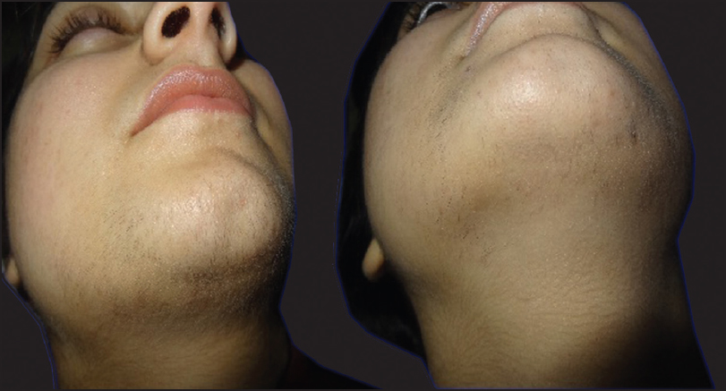 Pre and post-treatment of a 21-year-old female after eight sessions of IPL