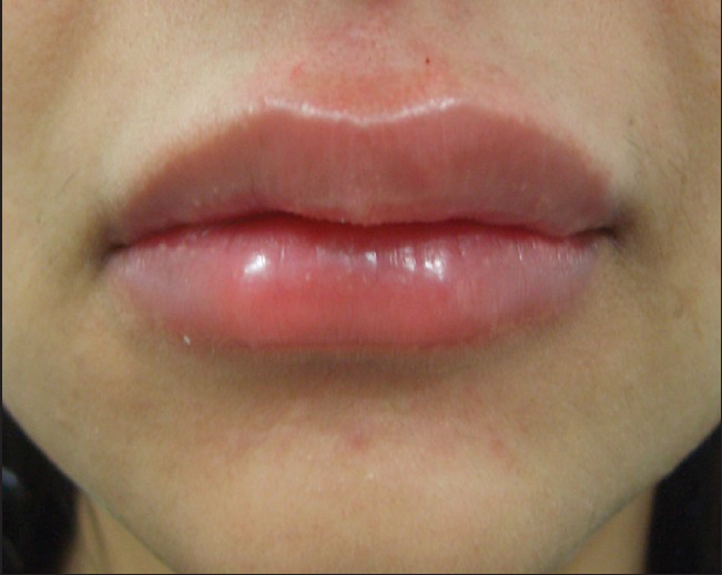 Swelling of the lips immediately after HA injection with needles