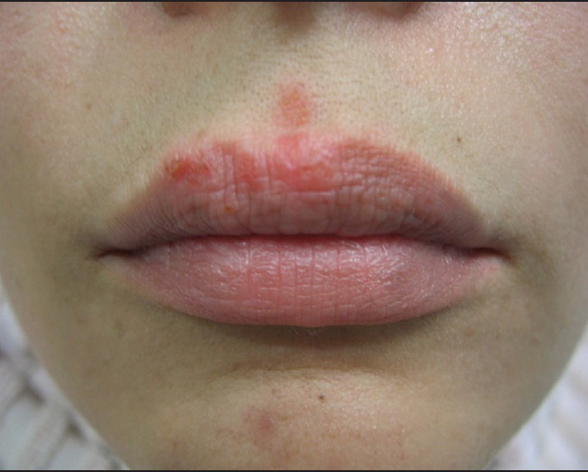 Herpetic reactivation after fillers