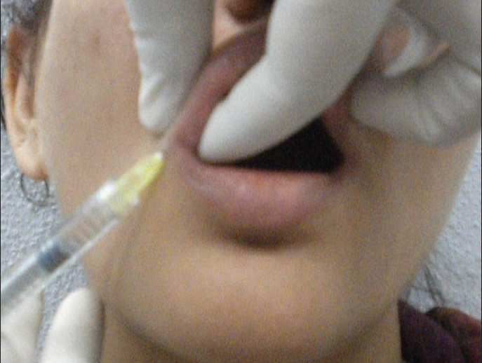 Lip augmentation with a cannula