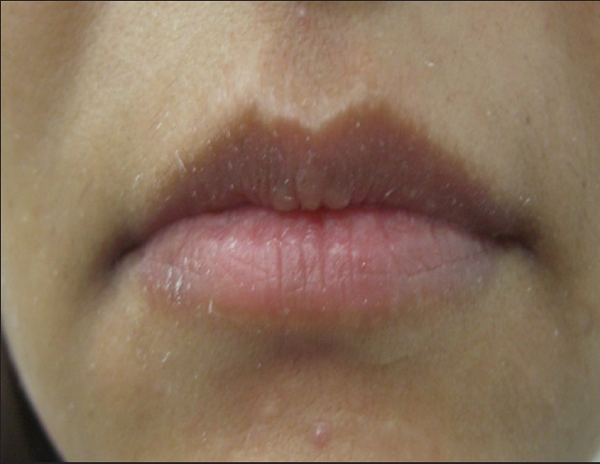 Shaping of upper and lower lips with 1 mL of HA: Pre-treatment