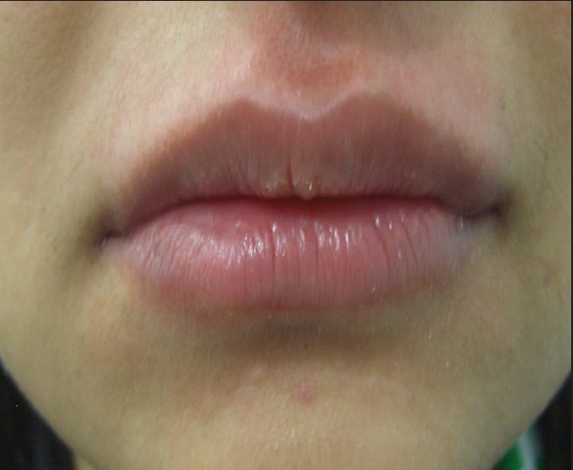 Shaping of upper and lower lips with 1 mL of HA: After treatment