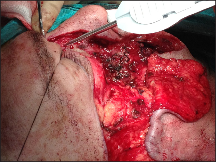 Postresection defect with advancement flap raised and Mitek anchors positioned