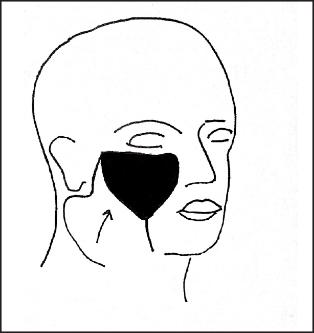 The drawing showing raising of cervicofacial advancement flap