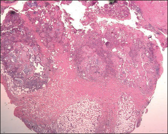 Scanning microscopy of the excision specimen of the patient shown in Figure 2