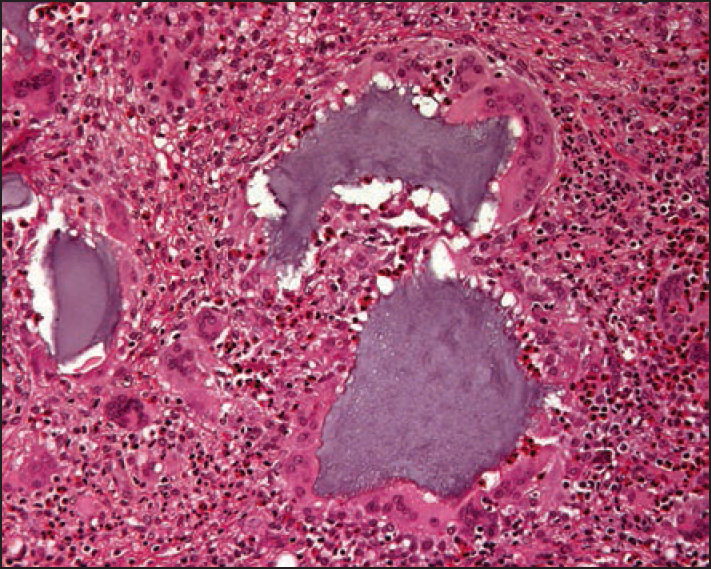 Medium paower histopathology photograph of the hyaluronic acid injection specimen showing clumps of basophilic hyaluronan, giant cells and huge masses of eosinophils