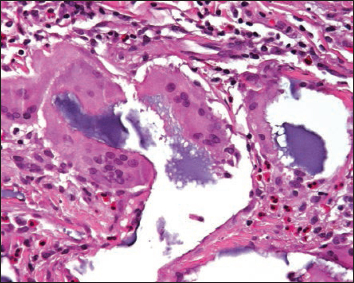 Close-up photograph of the hyaluronan granuloma with multinucleated giant cells engulfing the material as well as many eosinophils.