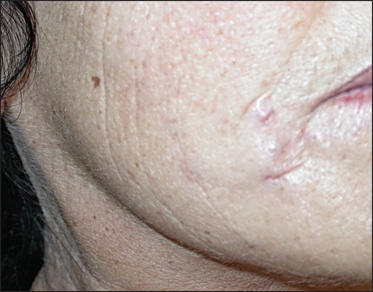 Female patient after injection of acrylic gel (Dermalive)