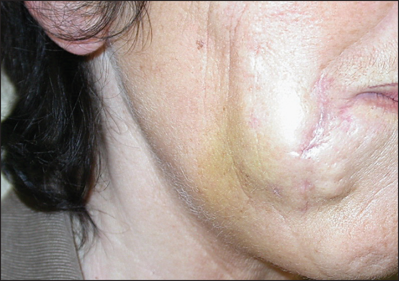 Stretching out the skin makes the granulomas more visible.