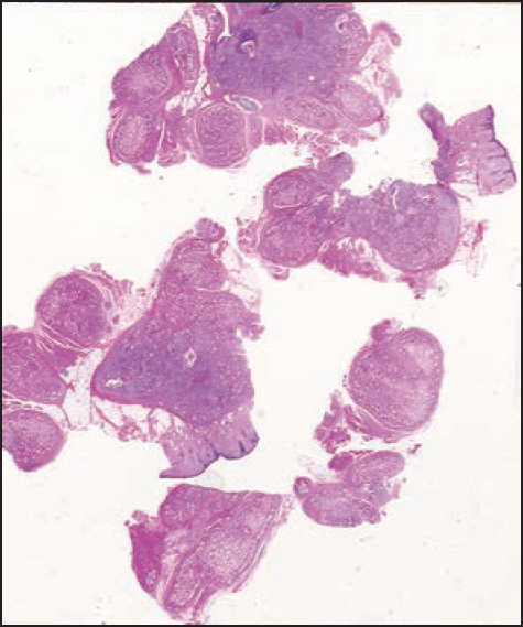 Scanning microscopy of the acrylic gel granulomas