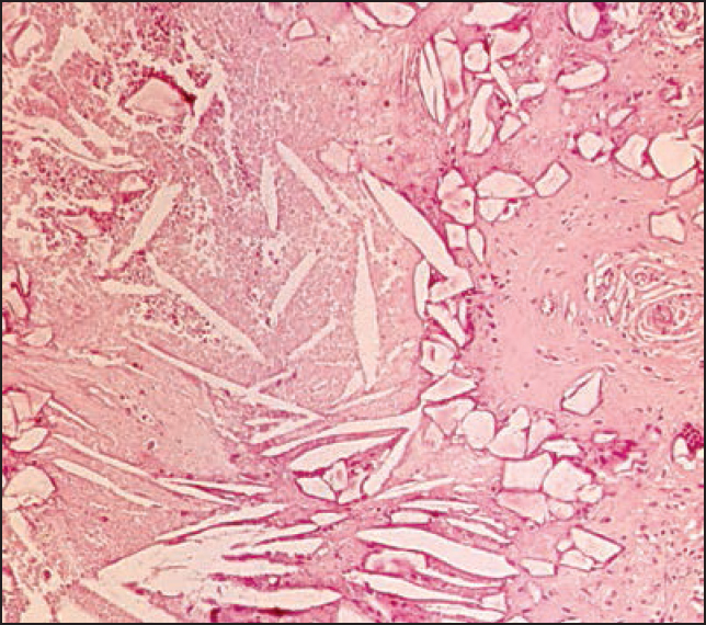 High magnification of an area in the granuloma showing long slender so-called cholesterol clefts in a necrotic tissue as well as smaller polyedric acrylic particles