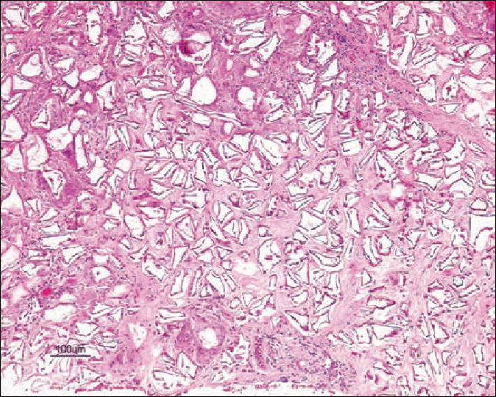 Area of the granuloma with multiple acrylic gel particles