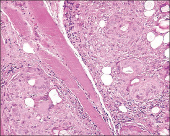 Mainly epithelioid cell granuloma with some giant cells and acrylic gel particles