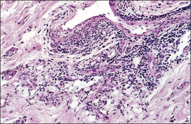 Dense lymphocytic infiltrates around vessels and small silicone droplets (lower margin) reminiscent of small fat cells