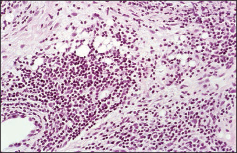 Adverse reaction to silicone displaying small silicone droplets