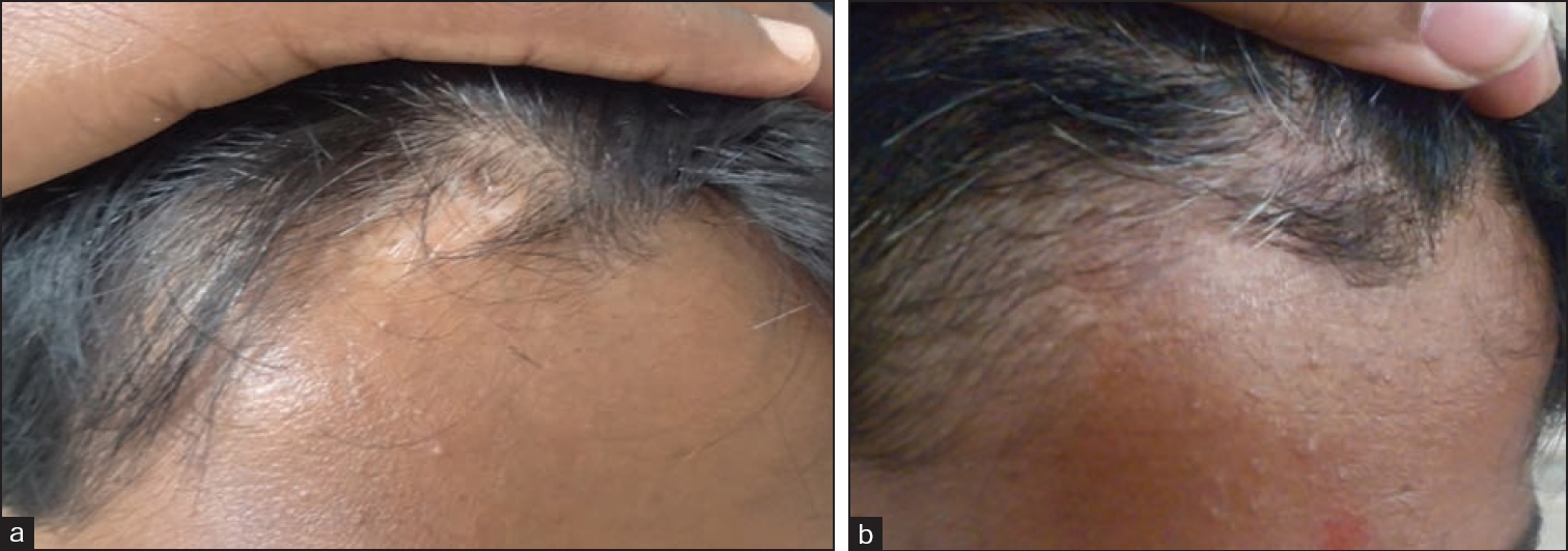 (a) Vitiligo lesion over scalp - before the procedure (b) Six months after the procedure; improvement in vitiligo and leukotrichia with excellent color match