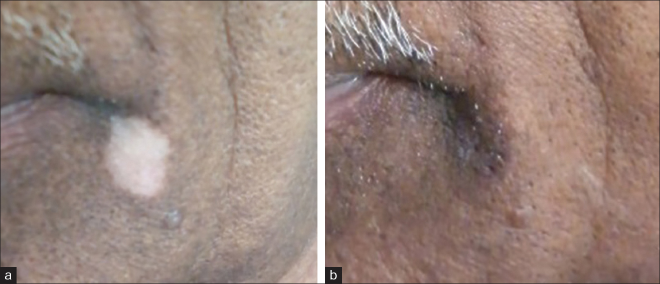 (a) Vitiligo lesion over the moustache before the procedure (b) Vitiligo lesion over the moustache area- 2 months after the procedure; excellent response to treatment with excellent color match