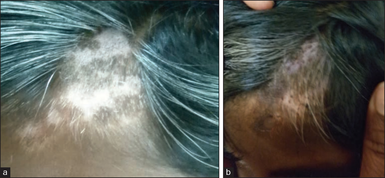 (a) Vitiligo with leukotrichia over the scalp (b) Vitiligo with leukotrichia over the scalp after 2 months