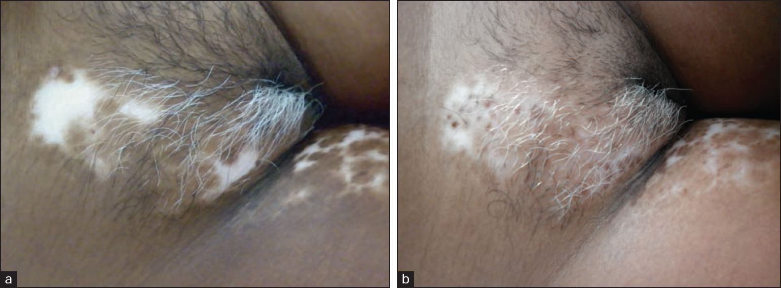 (a) Vitiligo lesions over the mons pubis before the procedure (b) Vitiligo lesions over the mons pubis 6 months after the procedure