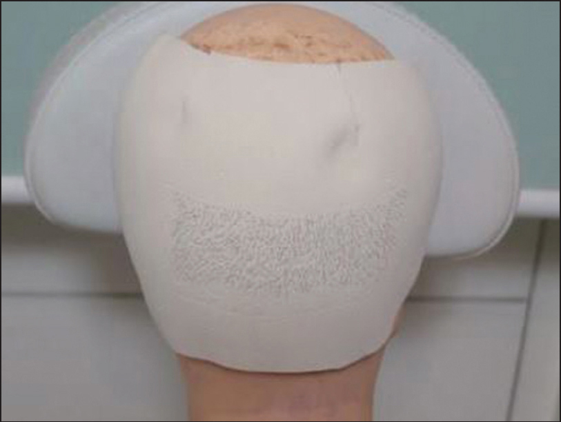 Dummy head covered with styrofoam and implanted with cut human hair (Photo courtesy:Dr Aman Dua & Dr Kapil Dua)