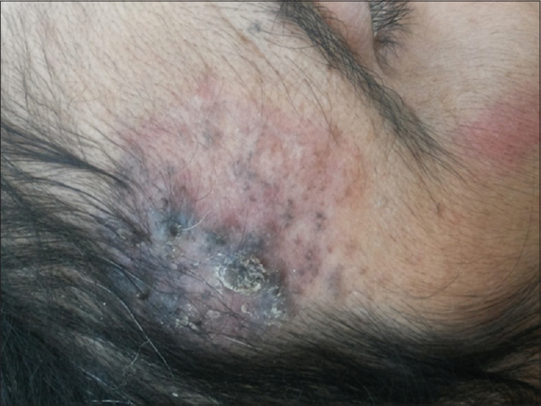 Hyperpigmentation and transient desquamation at the nevus site